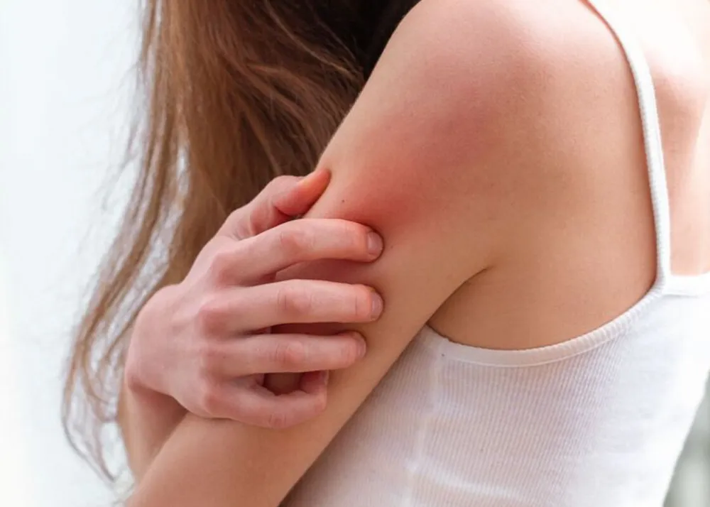 A person with inflammed, red skin