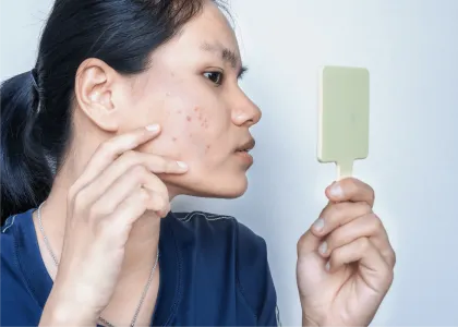 Adult Acne: Potential Causes, Solutions, and Prevention 1