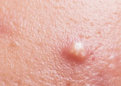 Adult Acne: Potential Causes, Solutions, and Prevention 2