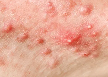 Adult Acne: Potential Causes, Solutions, and Prevention 4