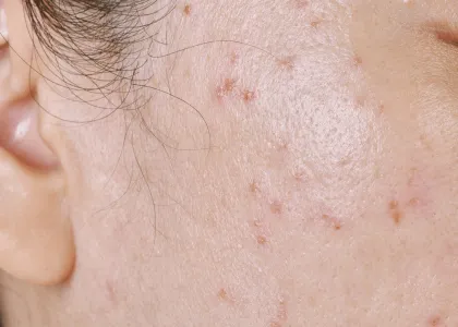Adult Acne: Potential Causes, Solutions, and Prevention 5