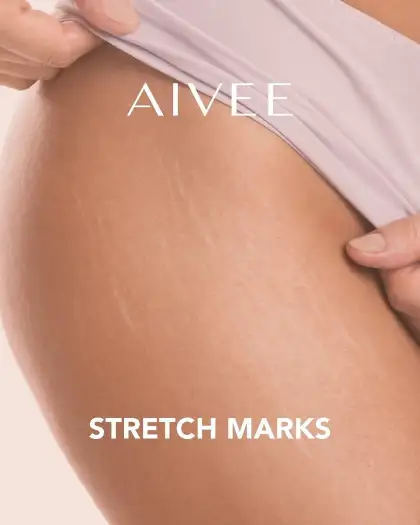 Aivee Clinic can help reduce stretch marks