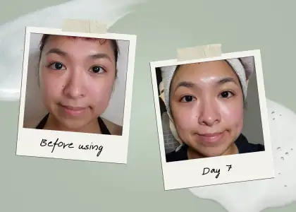 Before use and day 7 of using the Deoproce Acne Care Line