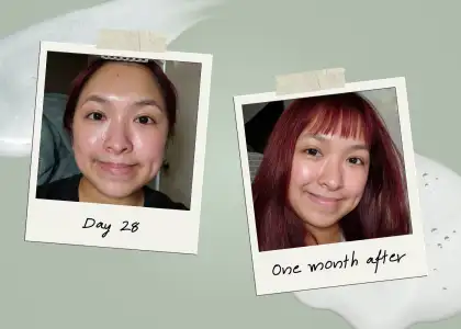 Results after one month sees visible results from Deoproce's Acne Care Line