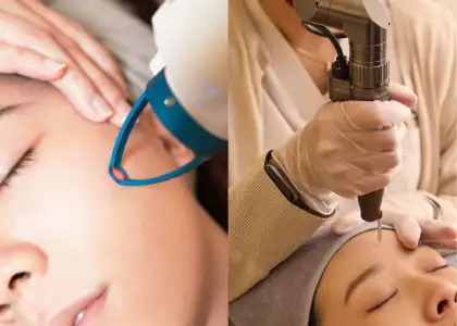 Capri Blue Laser and Hollywood Laser Treatment