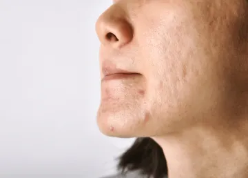 Adult Acne: Potential Causes, Solutions, and Prevention