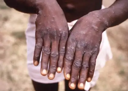 What does monkeypox look like